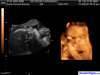 ecograf&iacute;a en 4D Karlo Iv&aacute;n con 29 semanas de gestaci&oacute;n